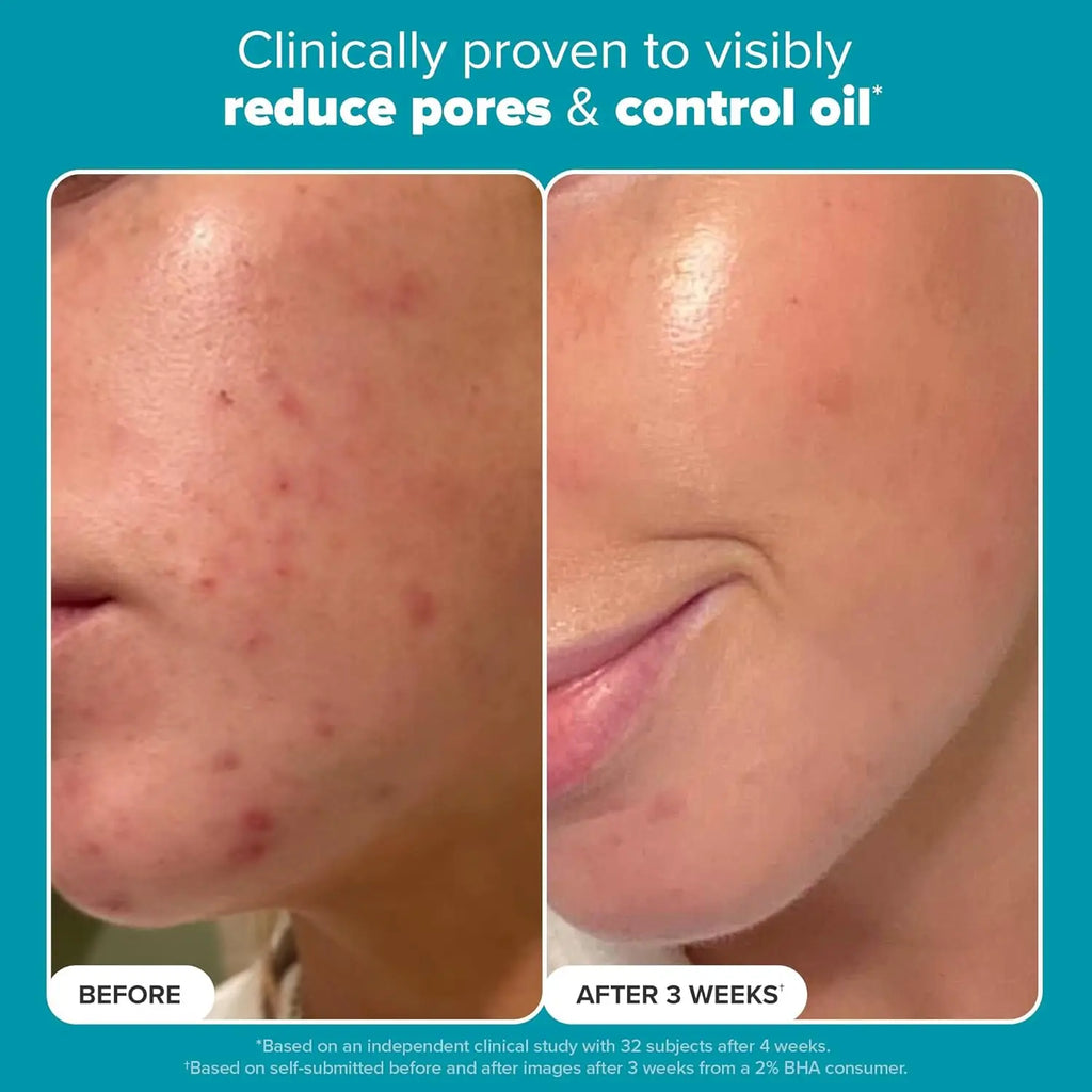 Paula's Choice SKIN PERFECTING 2% BHA Liquid Exfoliant